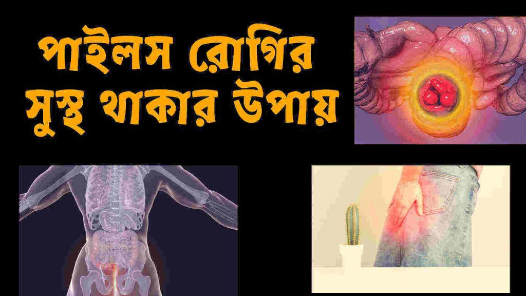 পাইলস এর লক্ষণ